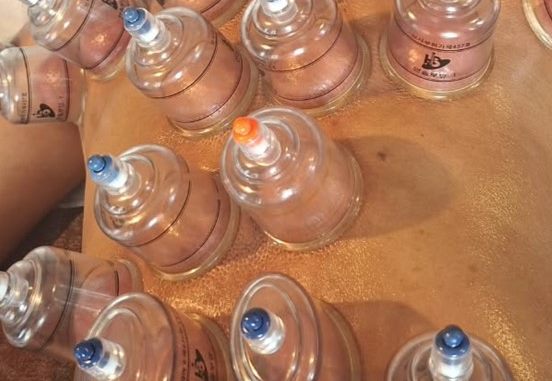 Dry cupping therapy with suction cups placed across the back in Athlone